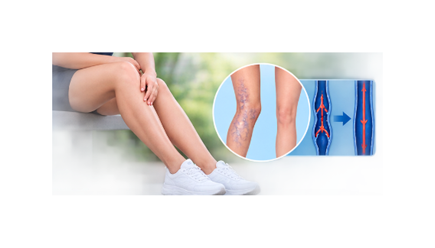 Varicose Veins Surgery